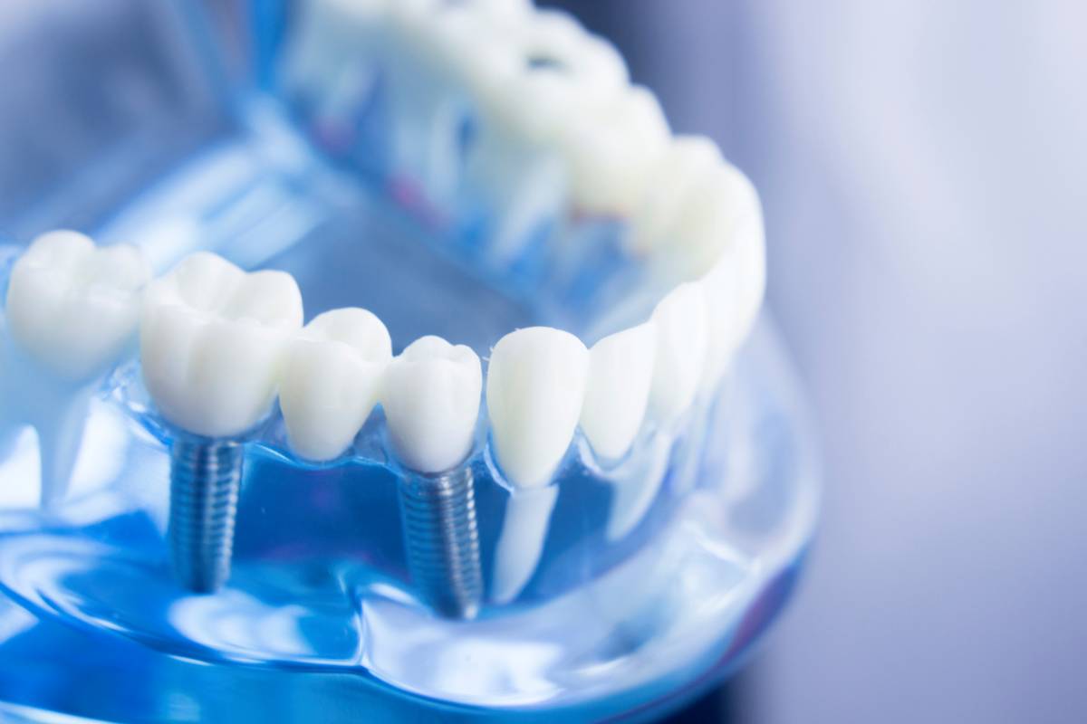 Concept of dental implants and health benefits