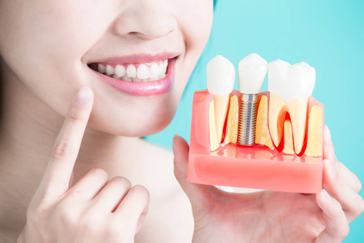 Young woman smiling holding a model of dental implants.