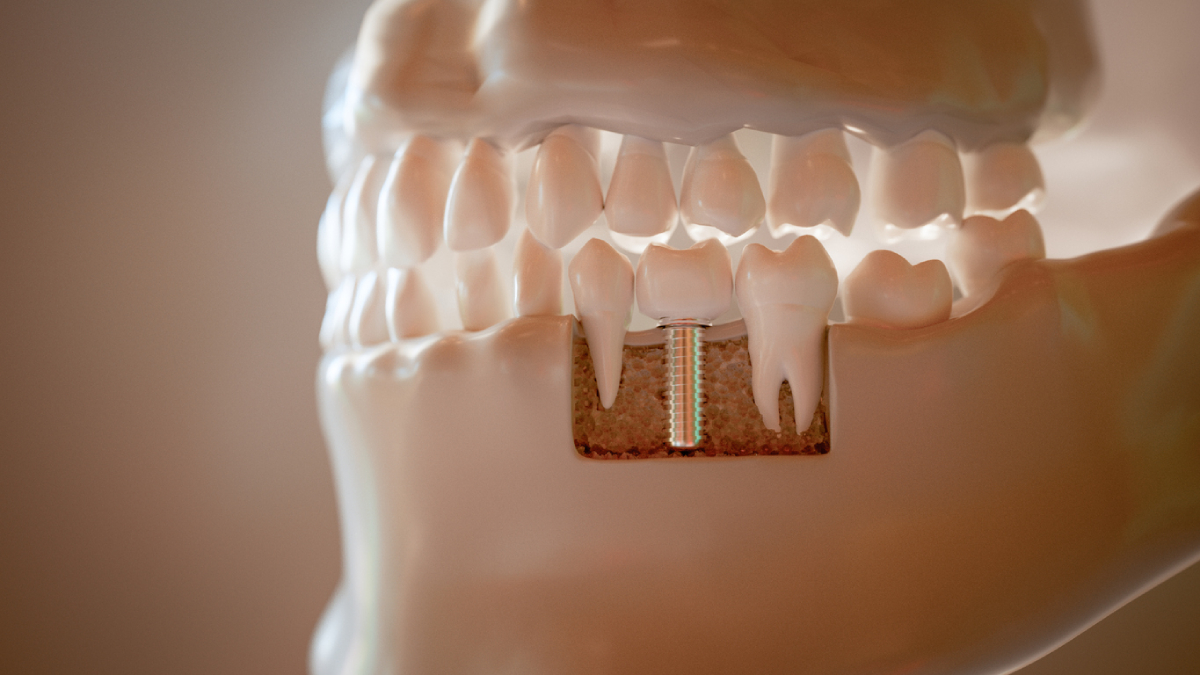 Featured image for Are There Any Side Effects to Getting Dental Implants?