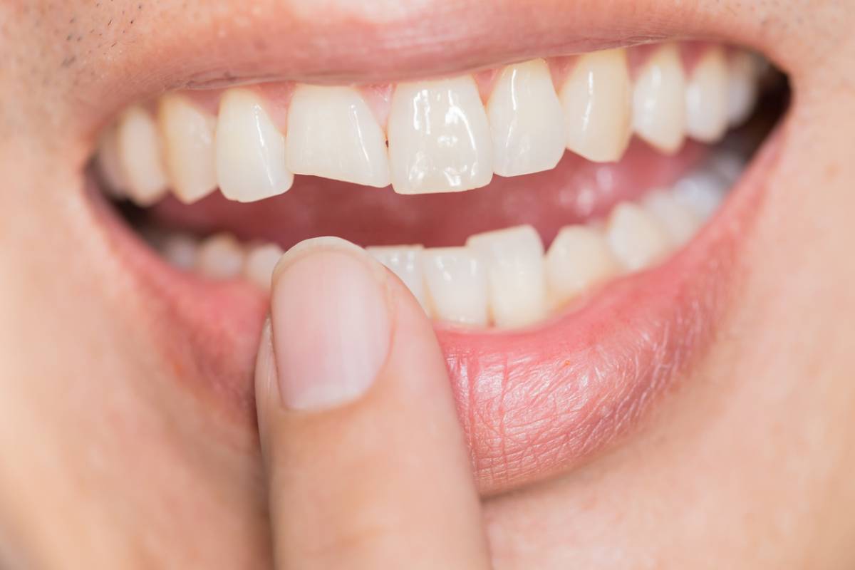 Patient with veneers that can break