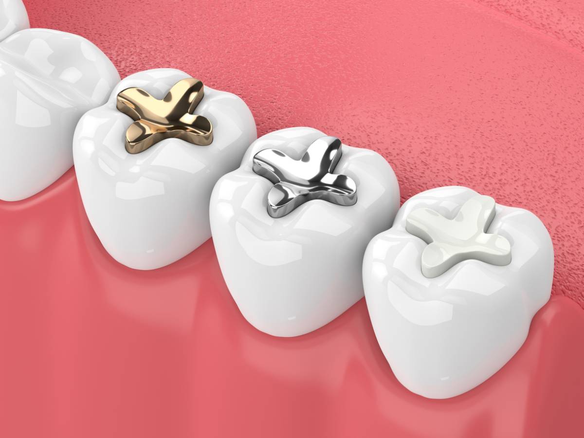 dental fillings material options 3d image
