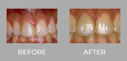 Dental Crown Patient Before & After picture