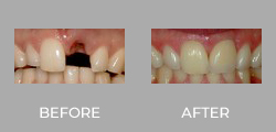 Dental Crown Patient Before & After picture