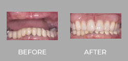 Dental Crown Patient Before & After picture