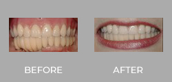 Dental Crown Patient Before & After picture