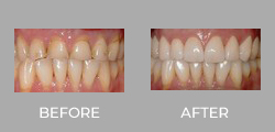 Dental Crown Patient Before & After picture