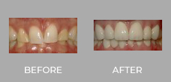 Dental Crown Patient Before & After picture