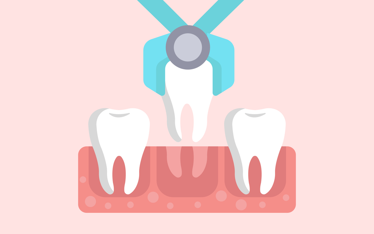 featured image for for I need an emergency tooth extraction