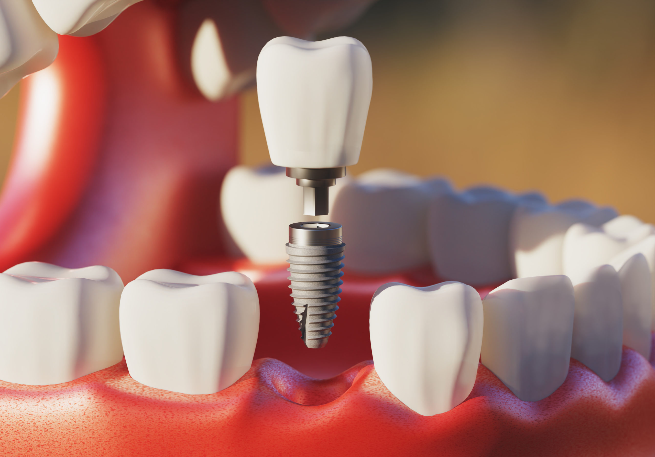 Dental implant screw, placement procedure