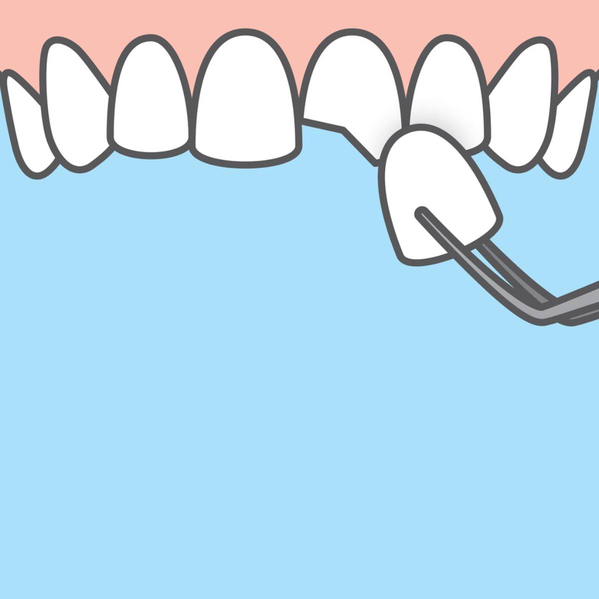 concept image of a veneer chipped and replaced