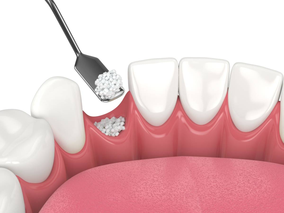 concept of preparing for dental implants with bone grafting