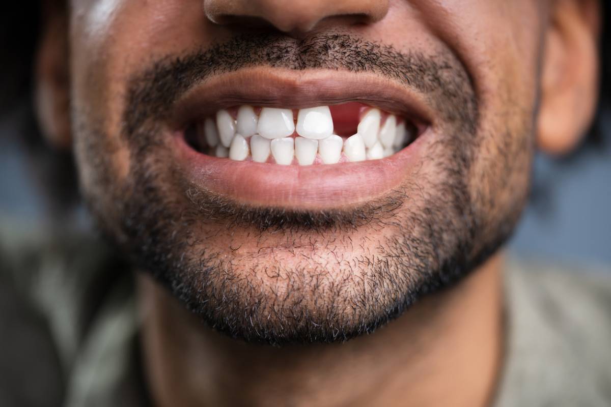 Man wanting to replace teeth after losing one.